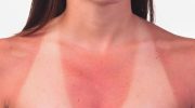 Pigens blod koger næsten i solen, hun er allergisk over for sollys