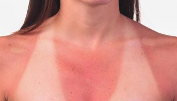 Pigens blod koger næsten i solen, hun er allergisk over for sollys