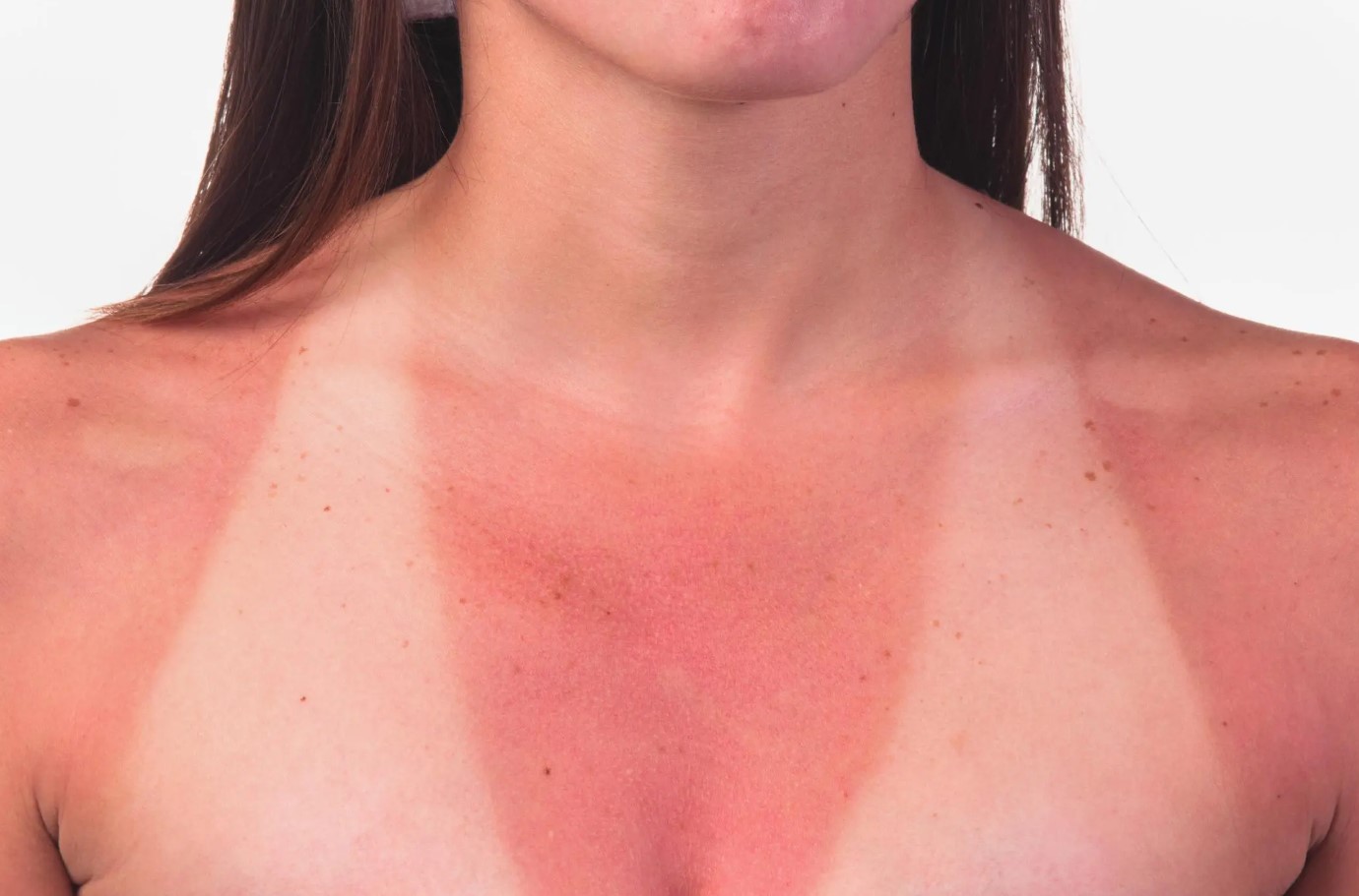Pigens blod koger næsten i solen, hun er allergisk over for sollys