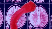 'Jeg er neurolog - 3 fødevarer, jeg ikke vil spise, fordi de kan give dig neurotoksiner eller hjerneparasitter'