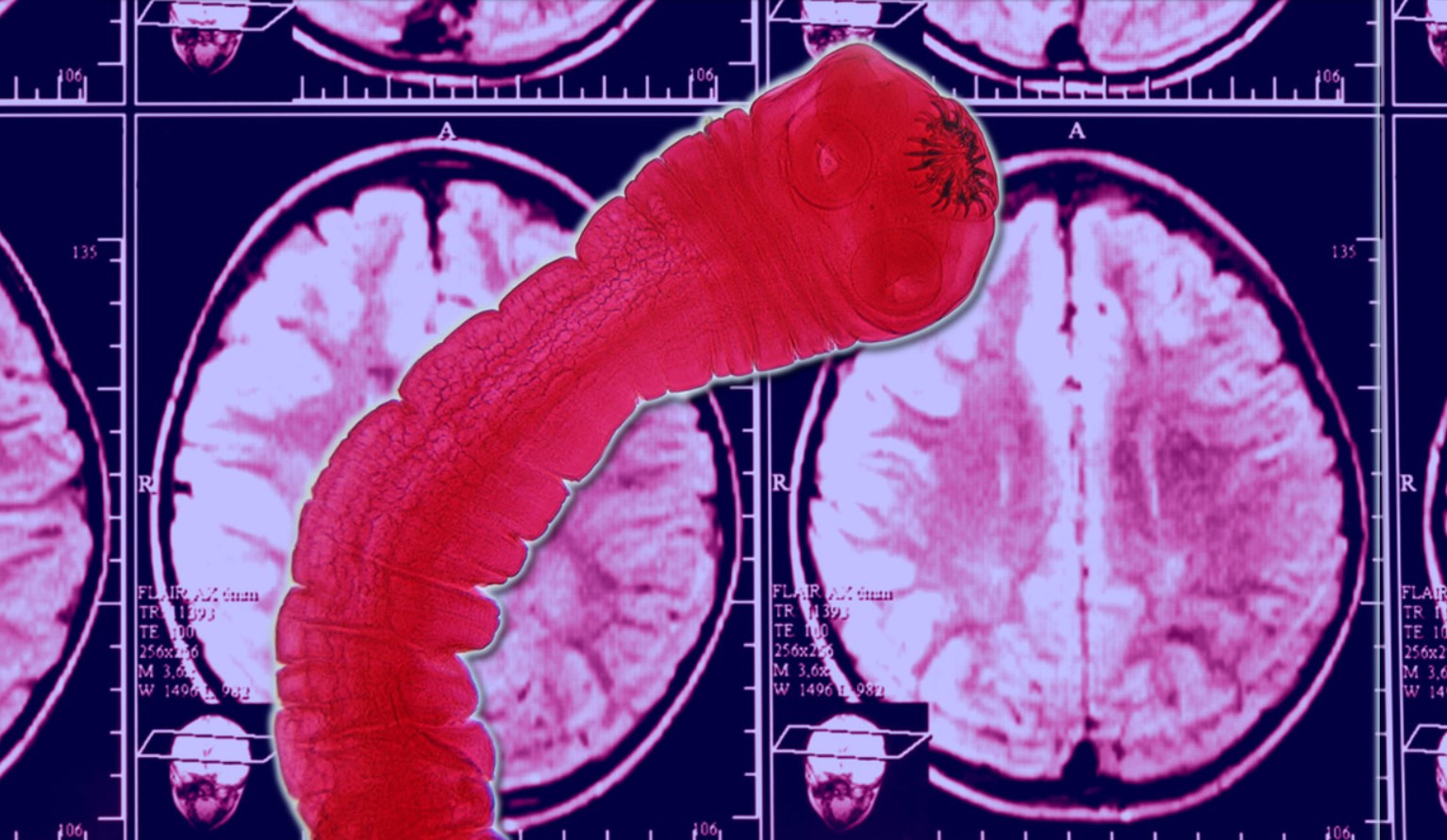 'Jeg er neurolog - 3 fødevarer, jeg ikke vil spise, fordi de kan give dig neurotoksiner eller hjerneparasitter'